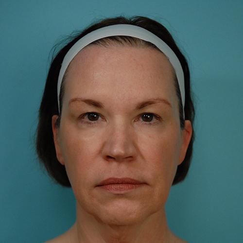 Facelift Before and After | Dr Evan W Beale