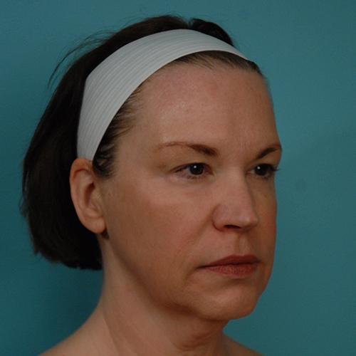 Facelift Before and After | Dr Evan W Beale