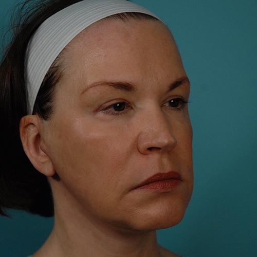 Facelift Before and After | Dr Evan W Beale