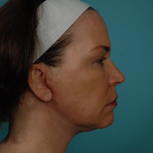 Facelift Before and After | Dr Evan W Beale