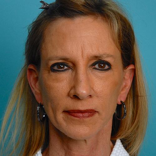 Facelift Before and After | Dr Evan W Beale