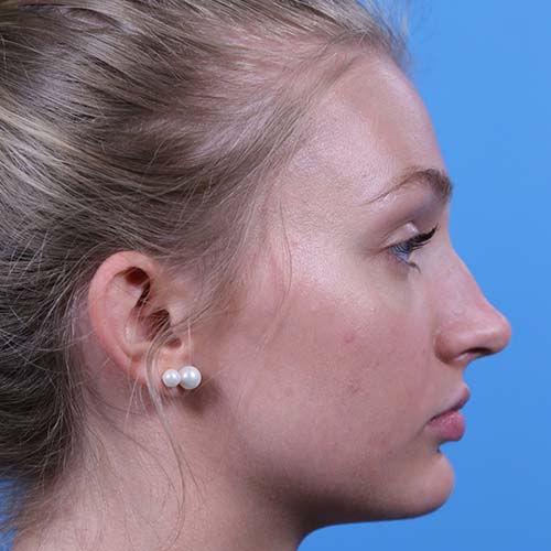 Rhinoplasty Before and After | Dr Evan W Beale