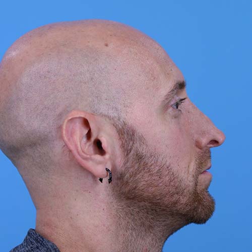 Rhinoplasty Before and After | Dr Evan W Beale