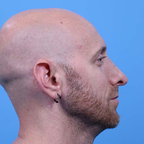 Rhinoplasty Before and After | Dr Evan W Beale