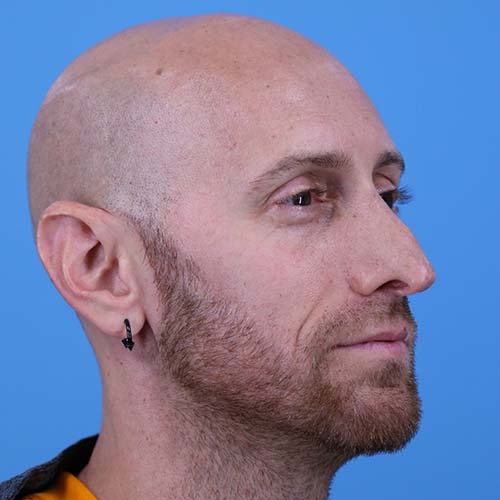 Rhinoplasty Before and After | Dr Evan W Beale