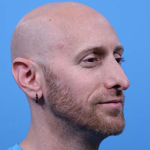 Rhinoplasty Before and After | Dr Evan W Beale
