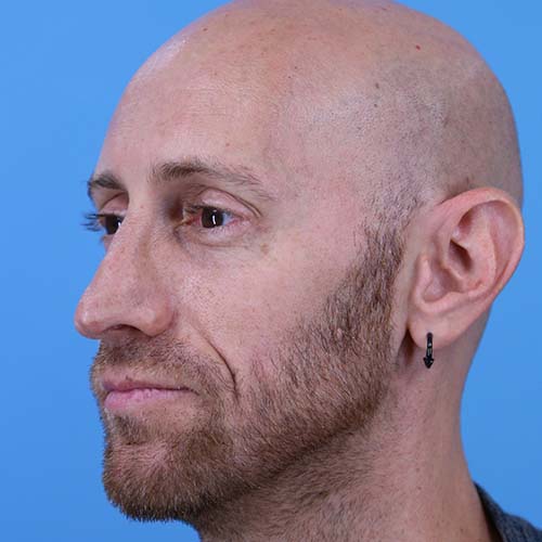 Rhinoplasty Before and After | Dr Evan W Beale