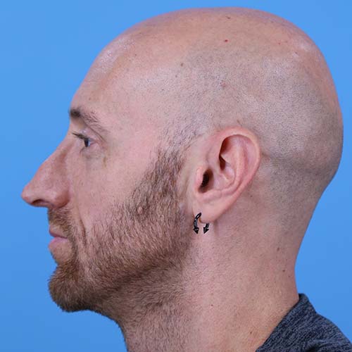 Rhinoplasty Before and After | Dr Evan W Beale