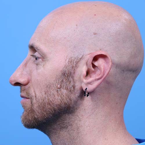 Rhinoplasty Before and After | Dr Evan W Beale