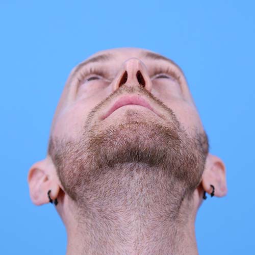 Rhinoplasty Before and After | Dr Evan W Beale