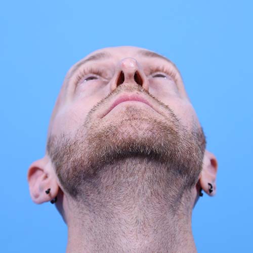 Rhinoplasty Before and After | Dr Evan W Beale