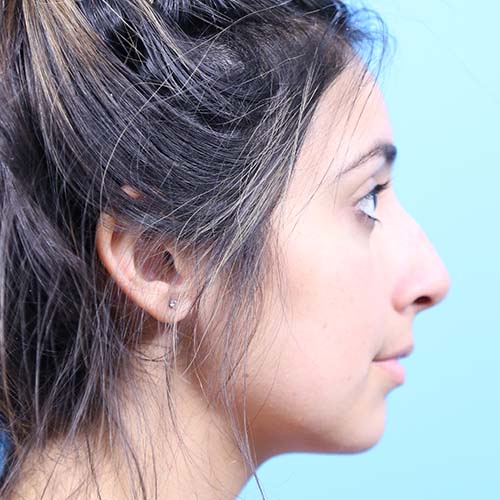 Rhinoplasty Before and After | Dr Evan W Beale