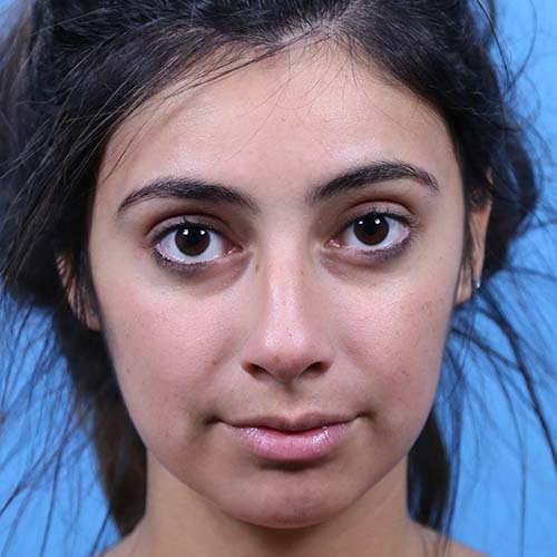 Rhinoplasty Before and After | Dr Evan W Beale