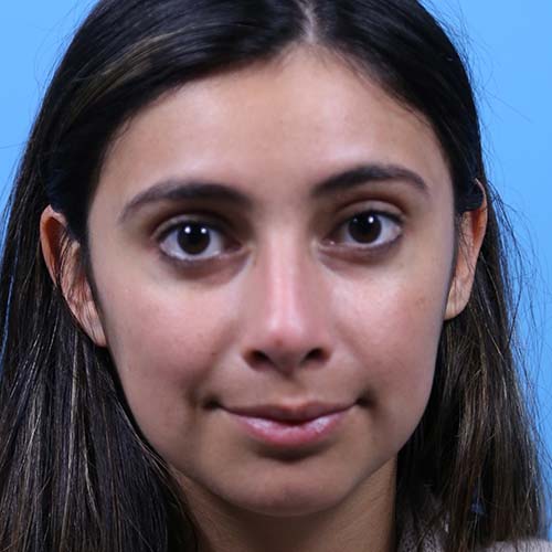 Rhinoplasty Before and After | Dr Evan W Beale