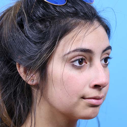 Rhinoplasty Before and After | Dr Evan W Beale