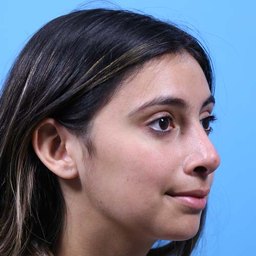 Rhinoplasty Before and After | Dr Evan W Beale