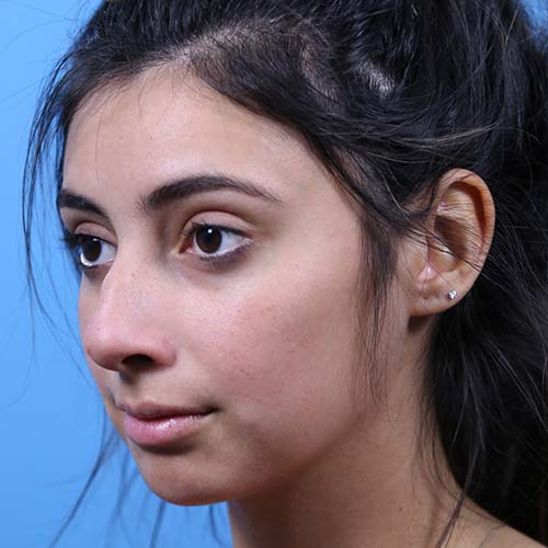 Rhinoplasty Before and After | Dr Evan W Beale