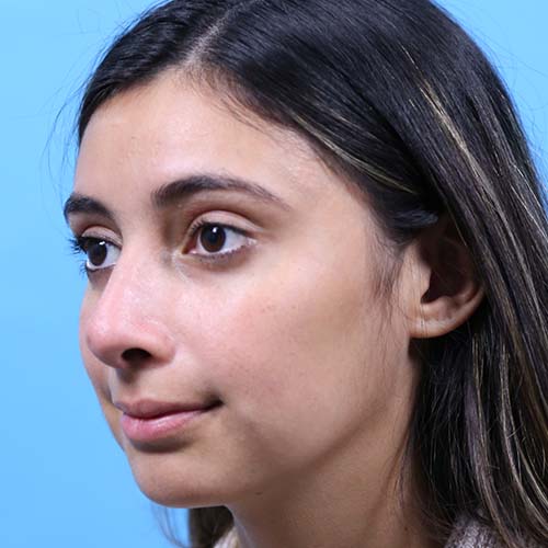 Rhinoplasty Before and After | Dr Evan W Beale