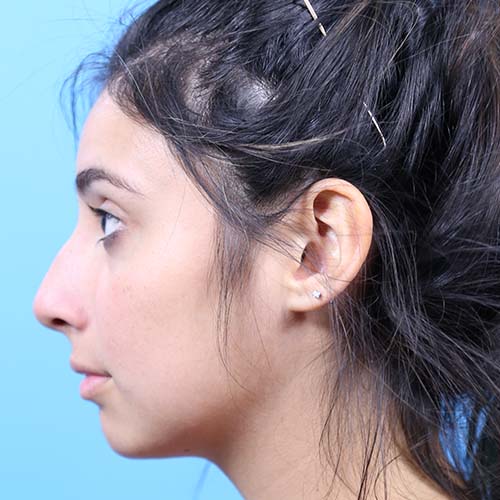 Rhinoplasty Before and After | Dr Evan W Beale