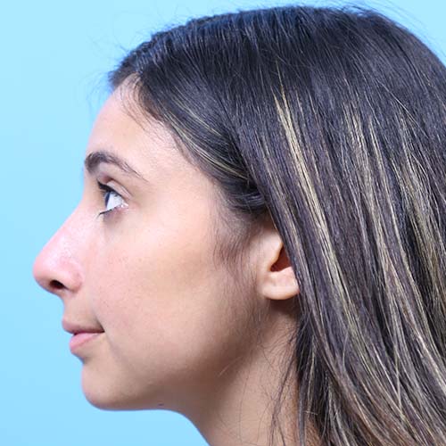 Rhinoplasty Before and After | Dr Evan W Beale