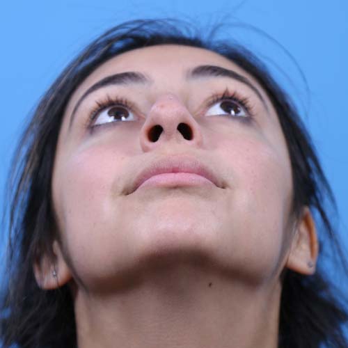 Rhinoplasty Before and After | Dr Evan W Beale