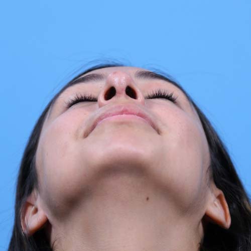 Rhinoplasty Before and After | Dr Evan W Beale