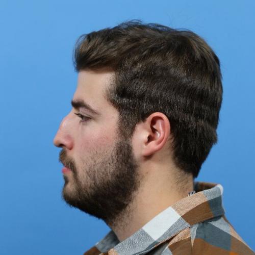 Rhinoplasty Before and After | Dr Evan W Beale