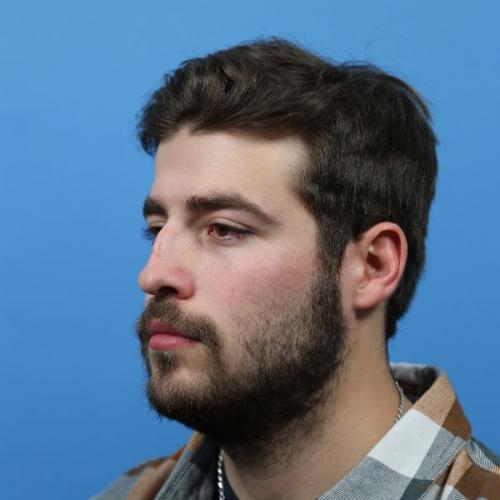 Rhinoplasty Before and After | Dr Evan W Beale