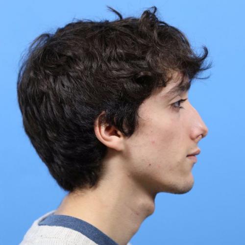 Rhinoplasty Before and After | Dr Evan W Beale