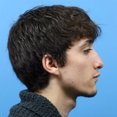 Rhinoplasty Before and After | Dr Evan W Beale