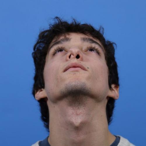 Rhinoplasty Before and After | Dr Evan W Beale