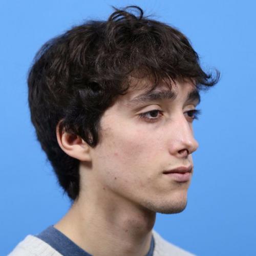 Rhinoplasty Before and After | Dr Evan W Beale