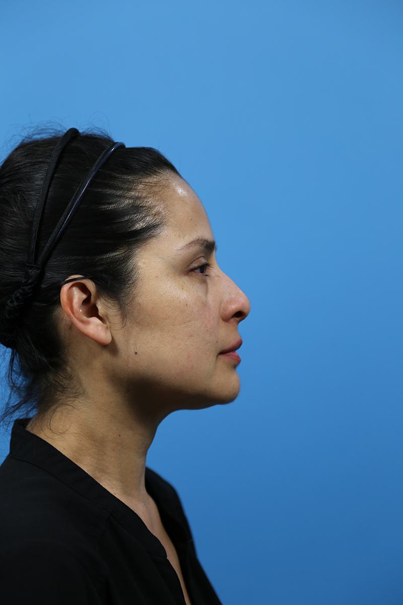 Rhinoplasty Before and After | Dr Evan W Beale