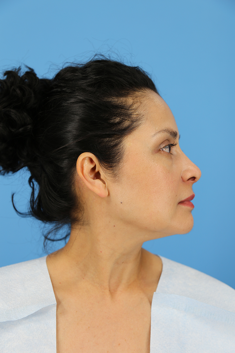 Rhinoplasty Before and After | Dr Evan W Beale