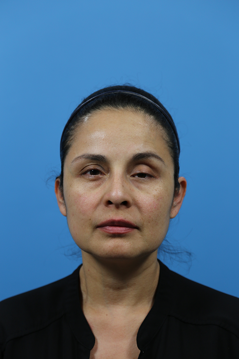 Rhinoplasty Before and After | Dr Evan W Beale