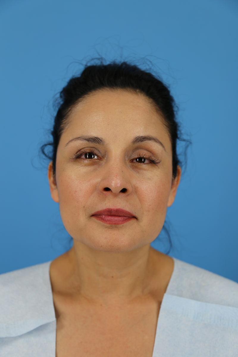 Rhinoplasty Before and After | Dr Evan W Beale