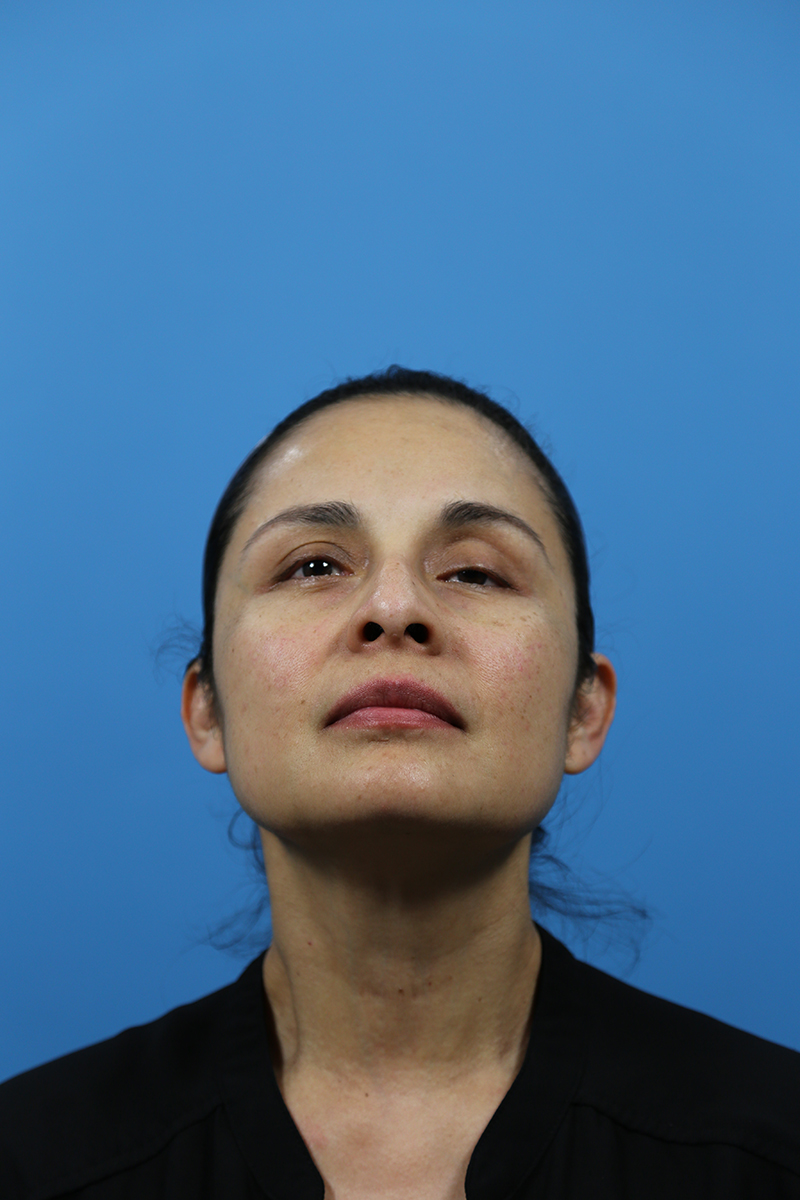 Rhinoplasty Before and After | Dr Evan W Beale