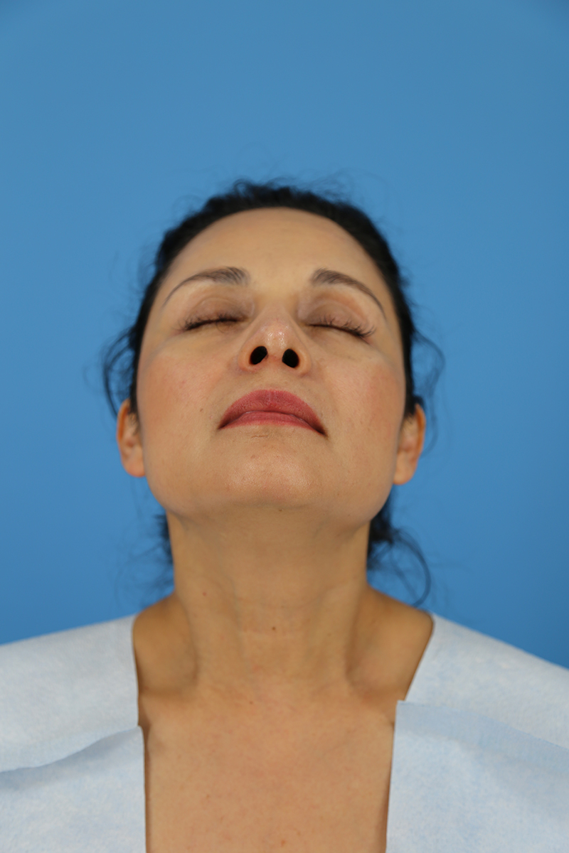 Rhinoplasty Before and After | Dr Evan W Beale