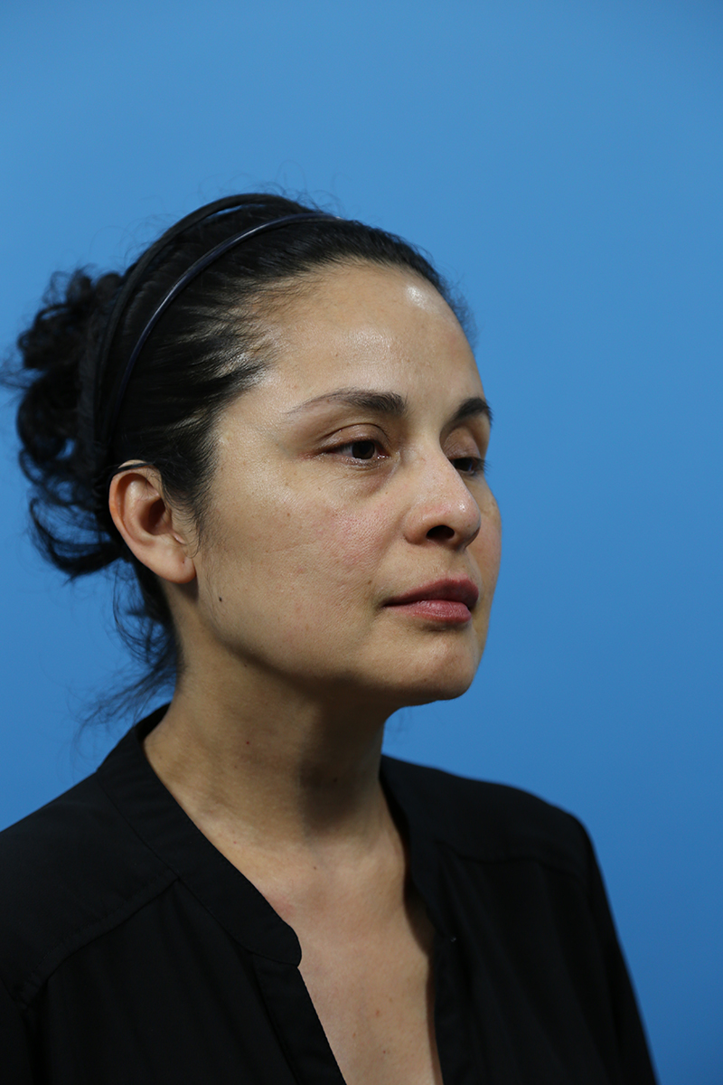Rhinoplasty Before and After | Dr Evan W Beale