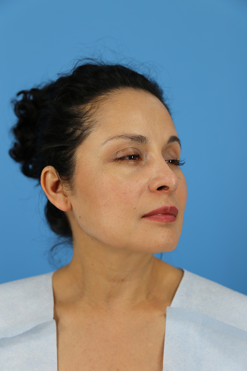 Rhinoplasty Before and After | Dr Evan W Beale