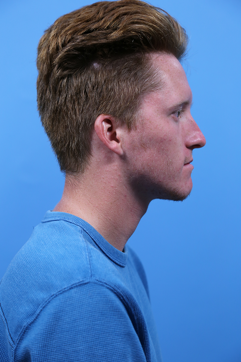 Rhinoplasty Before and After | Dr Evan W Beale