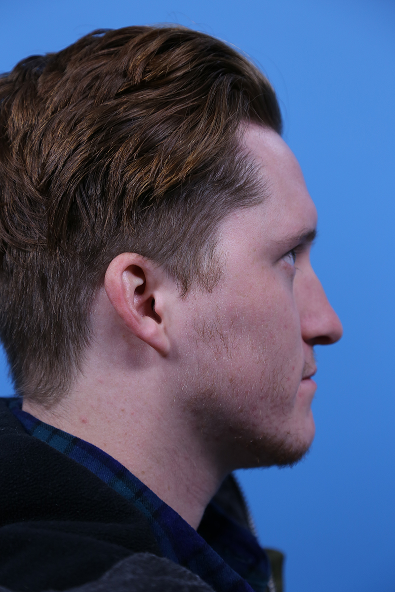 Rhinoplasty Before and After | Dr Evan W Beale