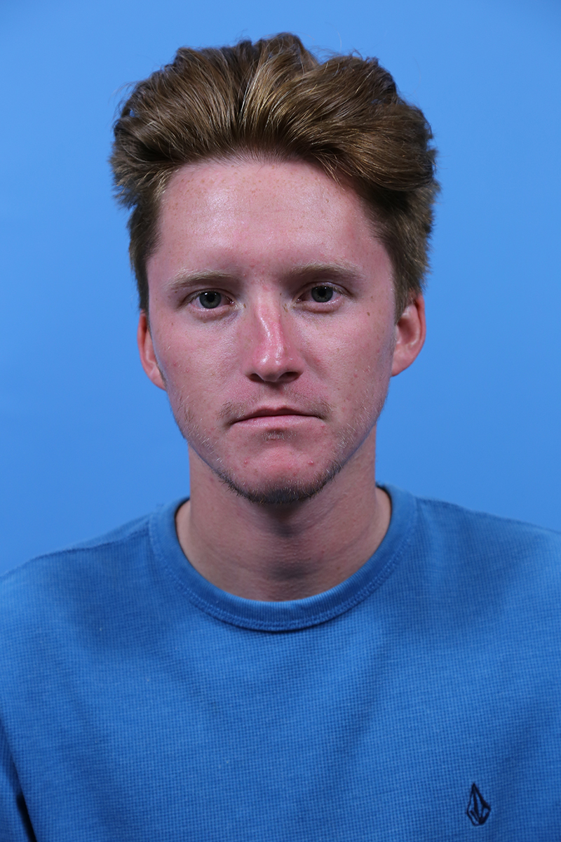 Rhinoplasty Before and After | Dr Evan W Beale