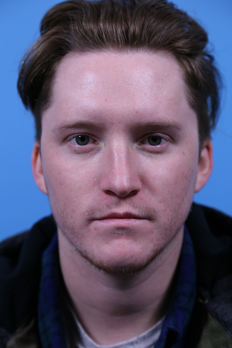 Rhinoplasty Before and After | Dr Evan W Beale