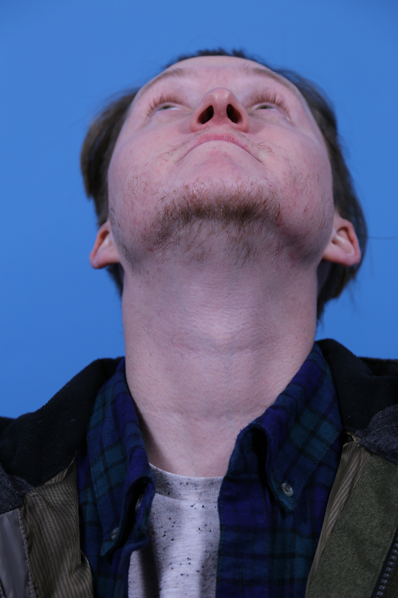 Rhinoplasty Before and After | Dr Evan W Beale