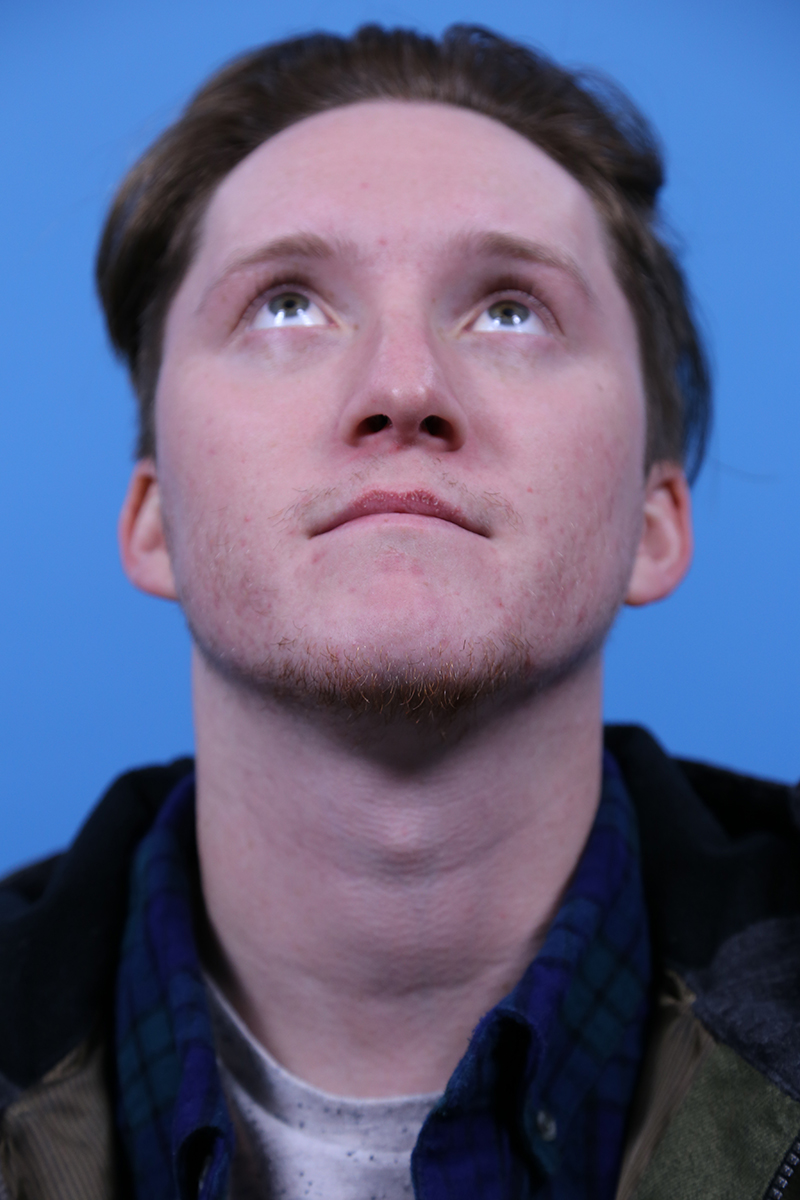 Rhinoplasty Before and After | Dr Evan W Beale