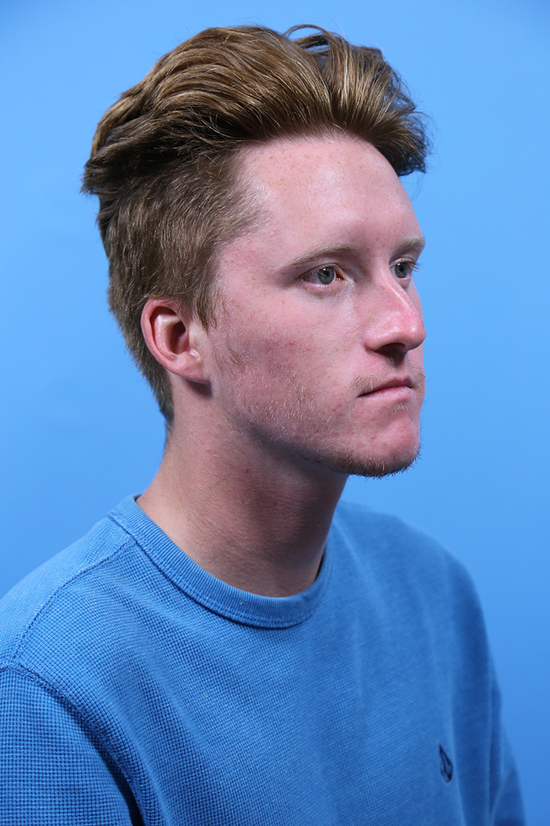 Rhinoplasty Before and After | Dr Evan W Beale