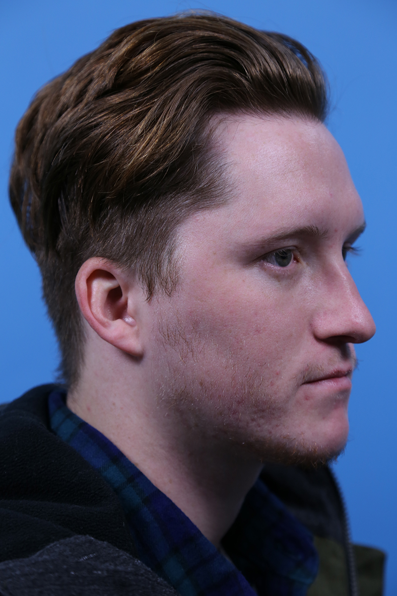 Rhinoplasty Before and After | Dr Evan W Beale