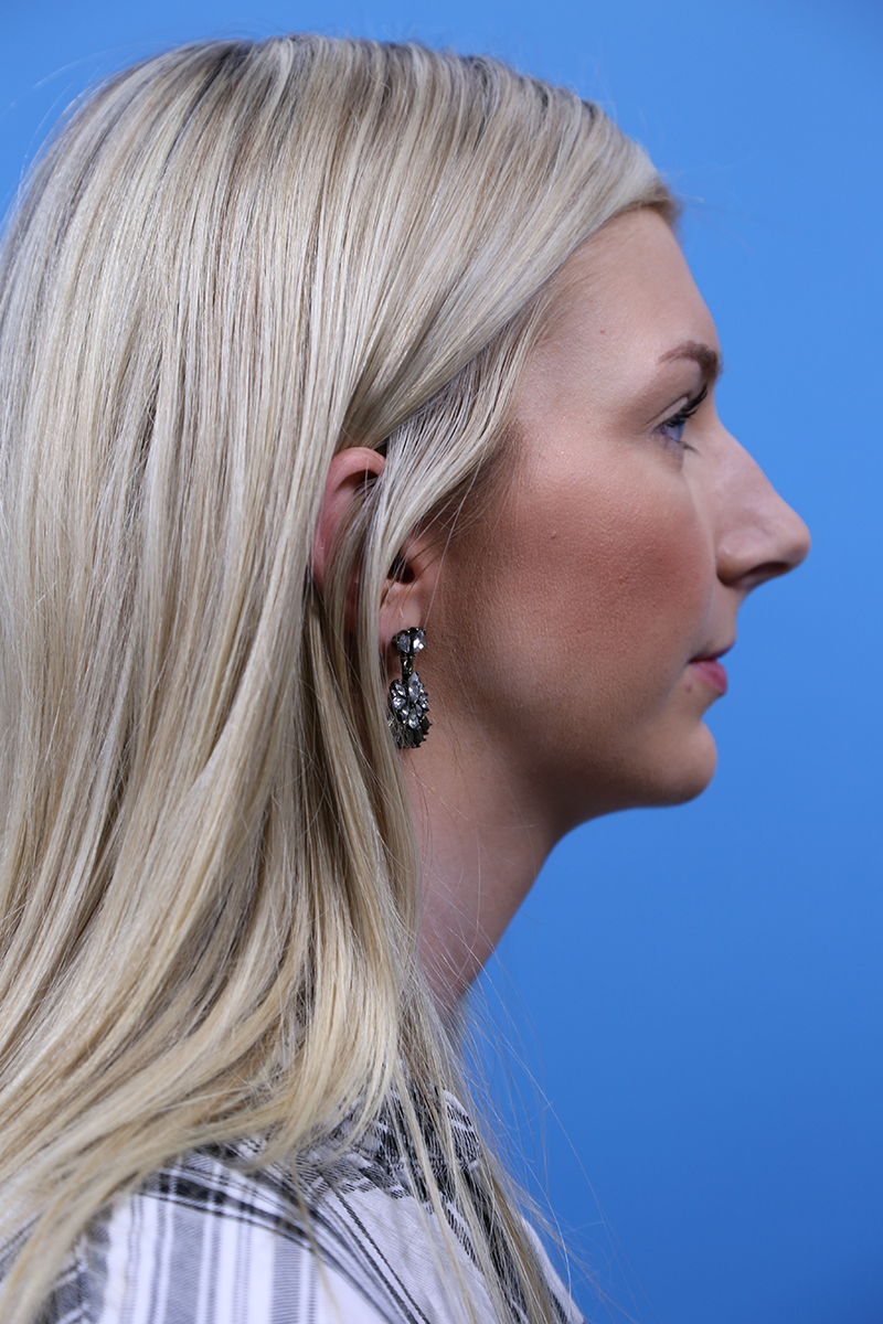 Rhinoplasty Before and After | Dr Evan W Beale