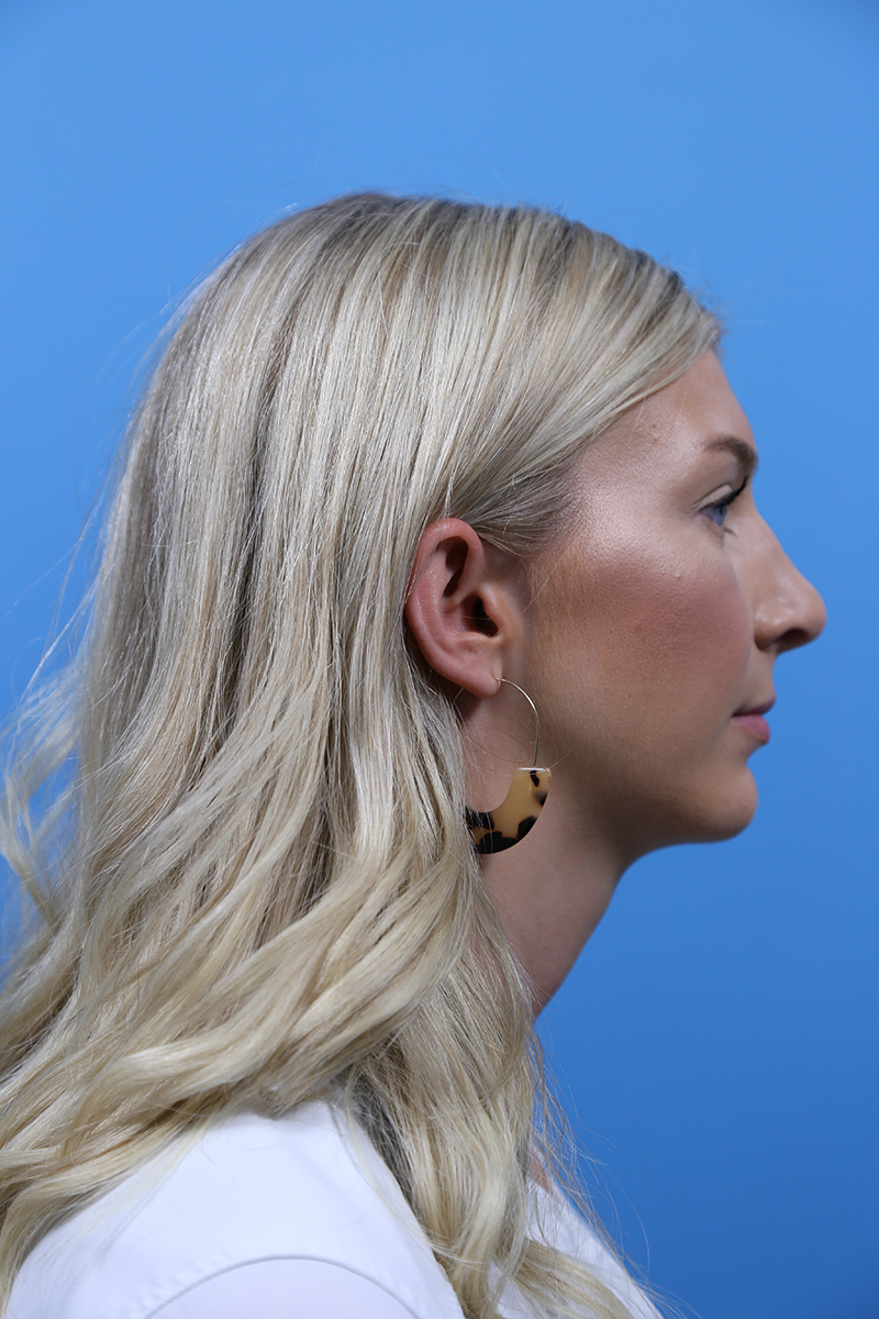 Rhinoplasty Before and After | Dr Evan W Beale